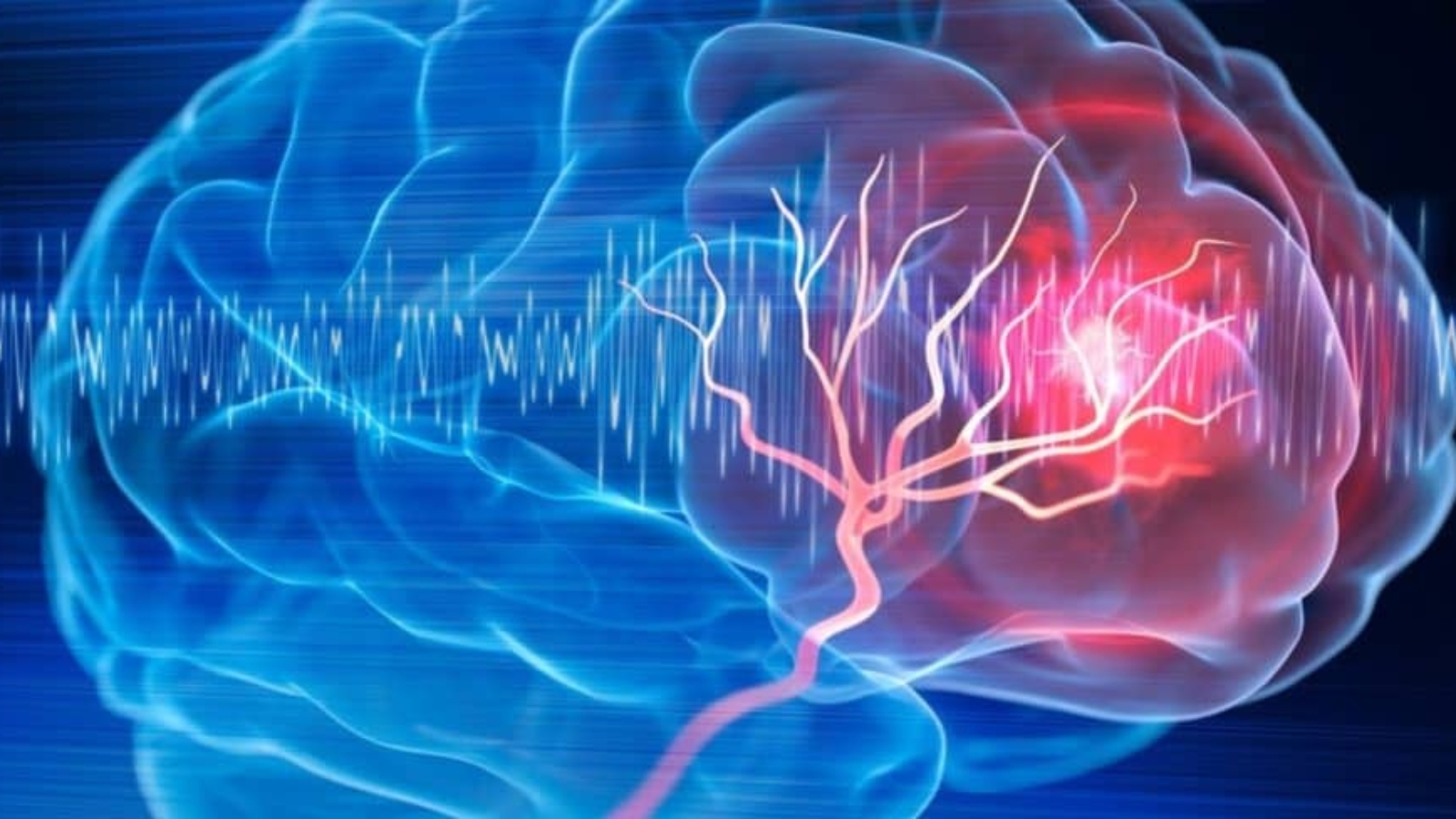 AVC-cerebral-1024x488